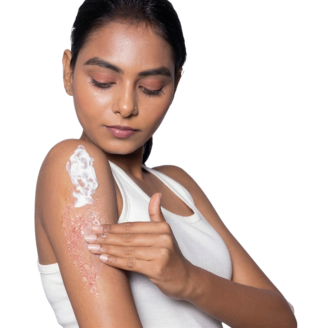 psoriosis relief without harsh chemicals