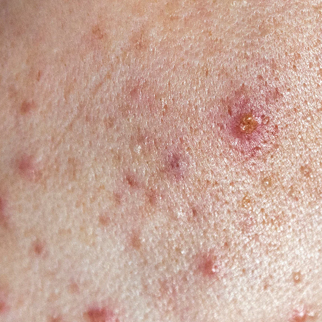 acne