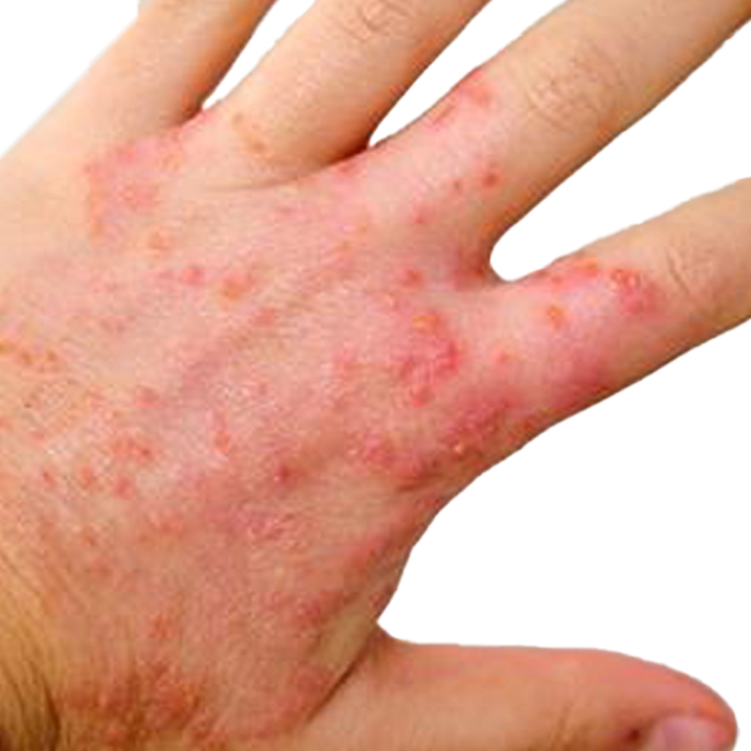 eczema