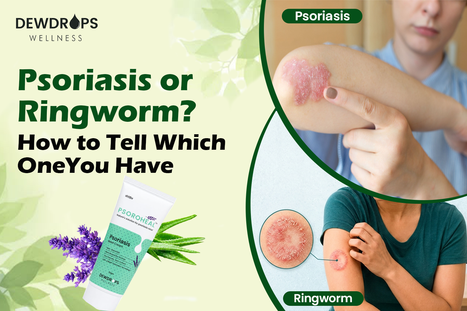 Psoriasis or Ringworm? How to Tell Which One You Have