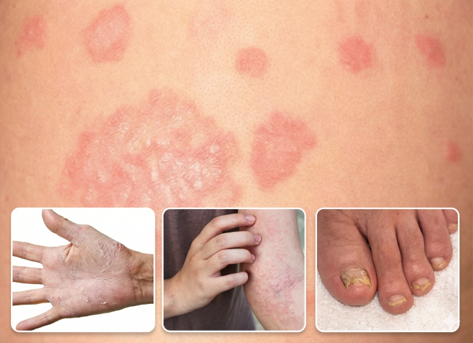 understanding psoriosis